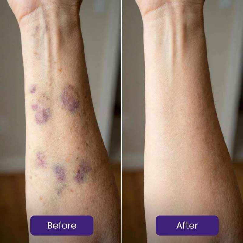Vitaecharm Body Oil for Bruising Skin